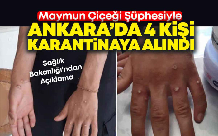 Ankara'da 4 Kişi M Çiçeği Şüphesiyle Karantinada