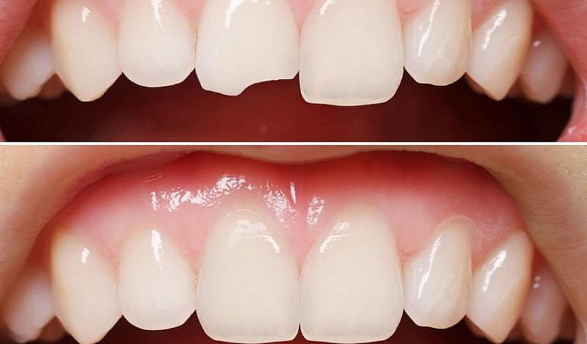 Beyaz Dolgunun Adresi Kırşehir Labordent Diş Polikliniği